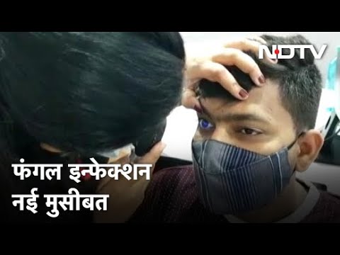 कोरोना के मरीजों के लिए जानलेवा बन रहा फंगल इन्फेक्शन